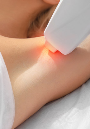 Epilation définitive